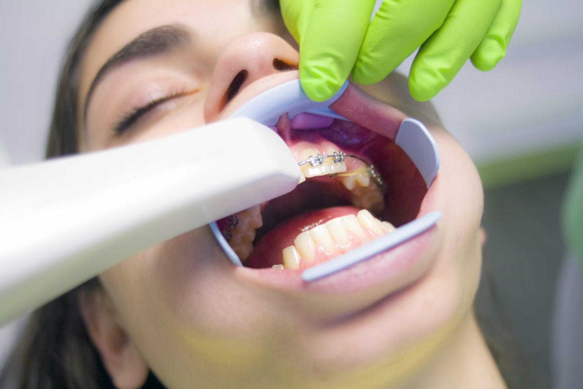 為什麼矯正線要一直換?矯正線粗細、材質不同代表什麼? 為什麼矯正線要一直換?矯正線粗細、材質不同代表什麼?